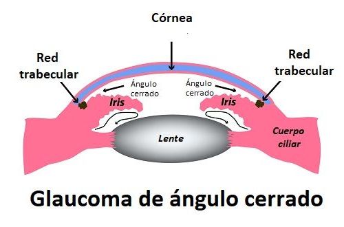 Glaucoma de Ángulo Abierto